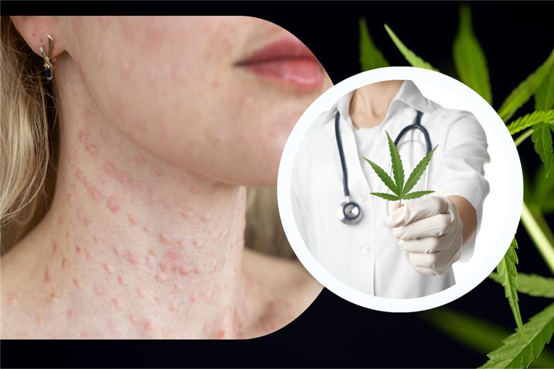Marijuana Allergy Symptoms Can You Be Allergic to Weed