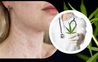 Marijuana Allergy Symptoms Can You Be Allergic to Weed