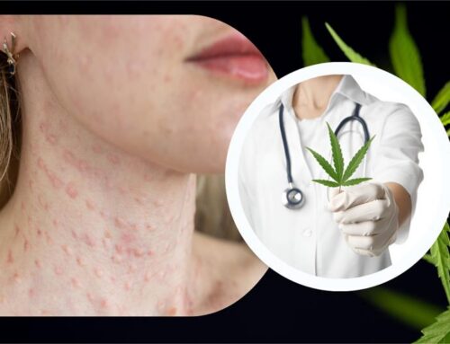 Marijuana Allergy Symptoms: Can You Be Allergic to Weed?